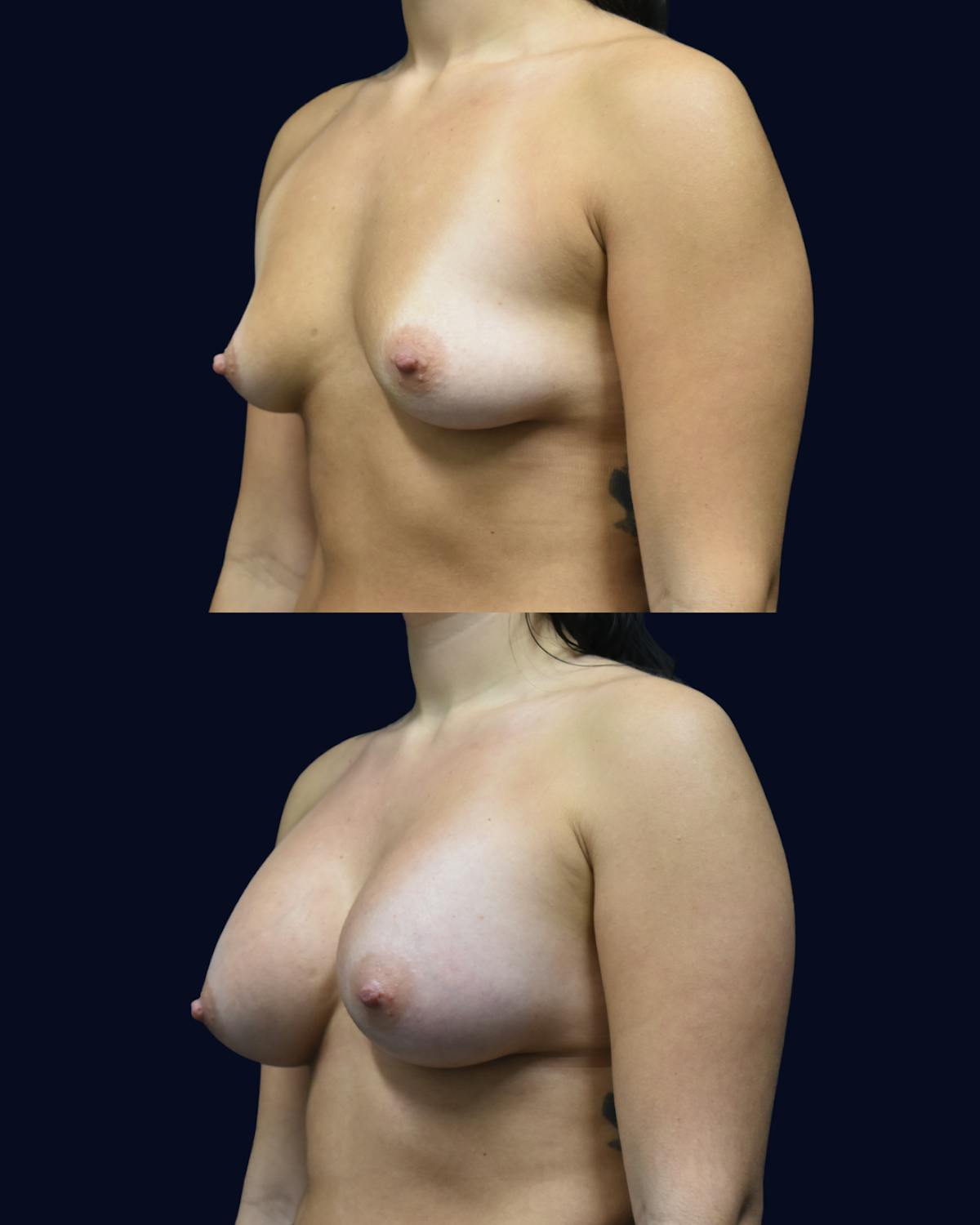 Breast Augmentation Before & After Gallery - Patient 358641 - Image 2
