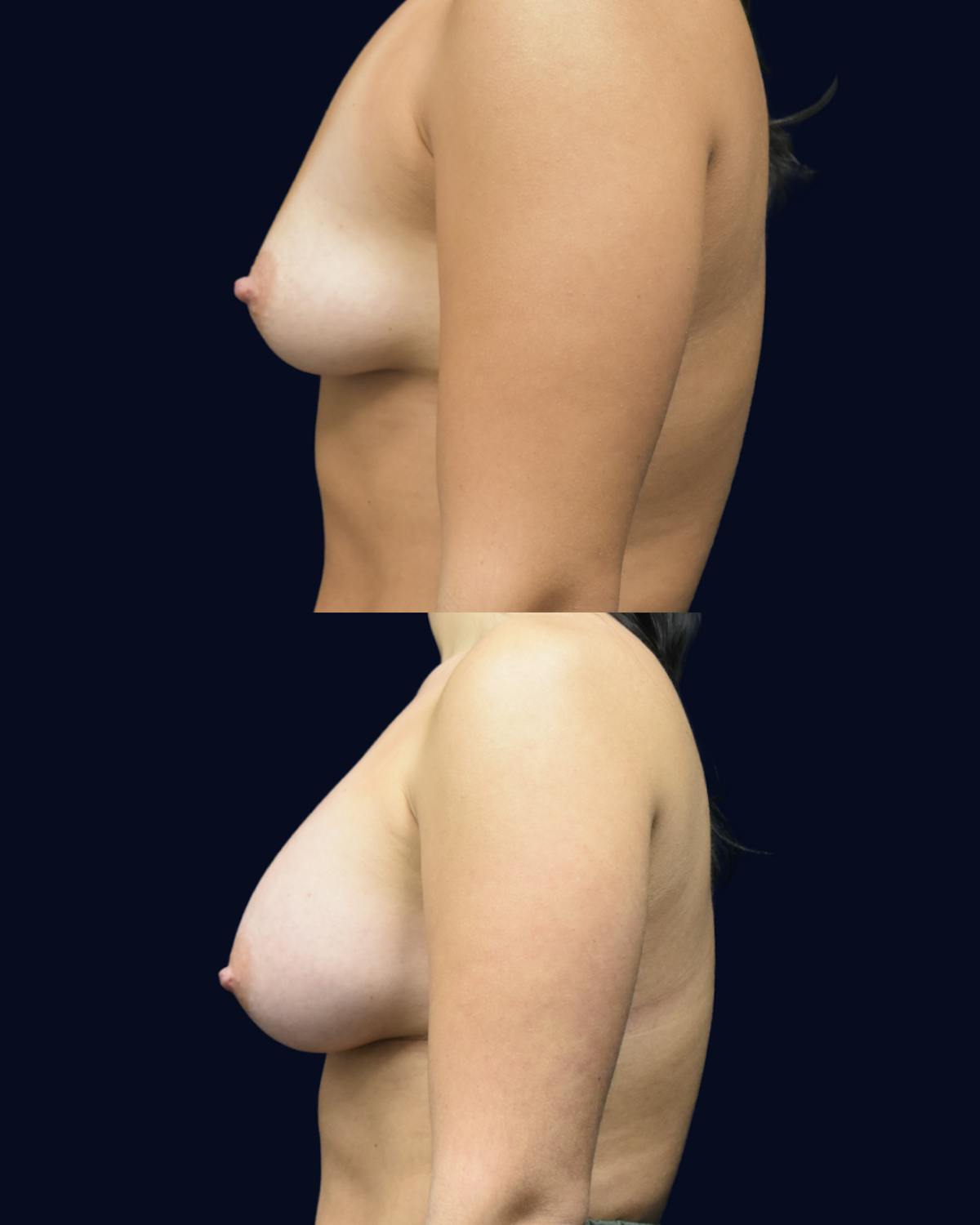 Breast Augmentation Before & After Gallery - Patient 358641 - Image 3