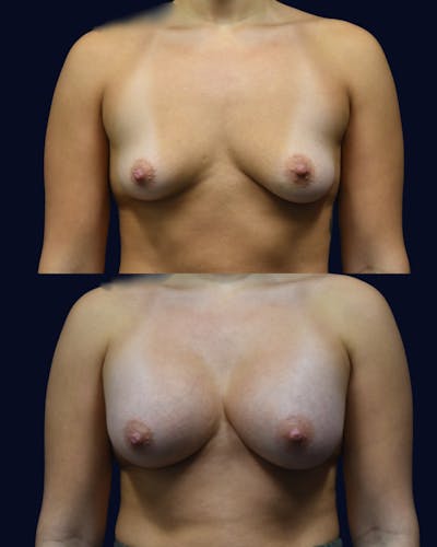 Breast Augmentation Before & After Gallery - Patient 358641 - Image 1