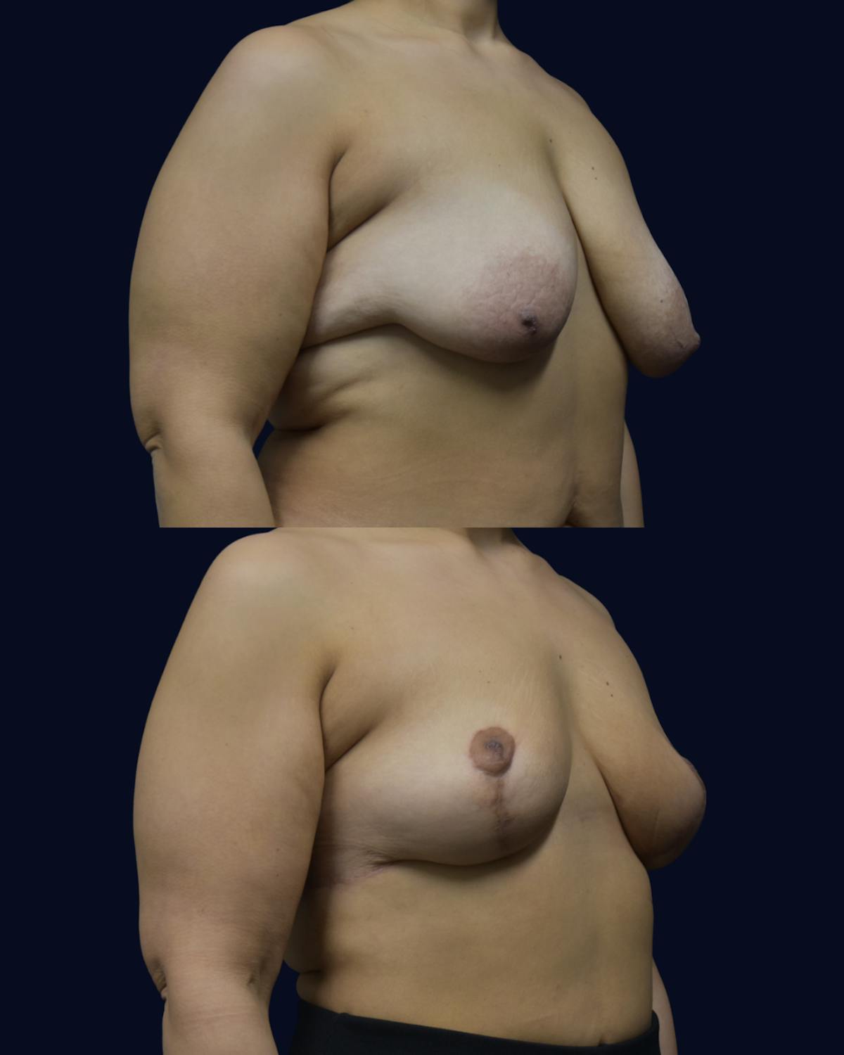 Breast Reduction and Lift Before & After Gallery - Patient 307852 - Image 2