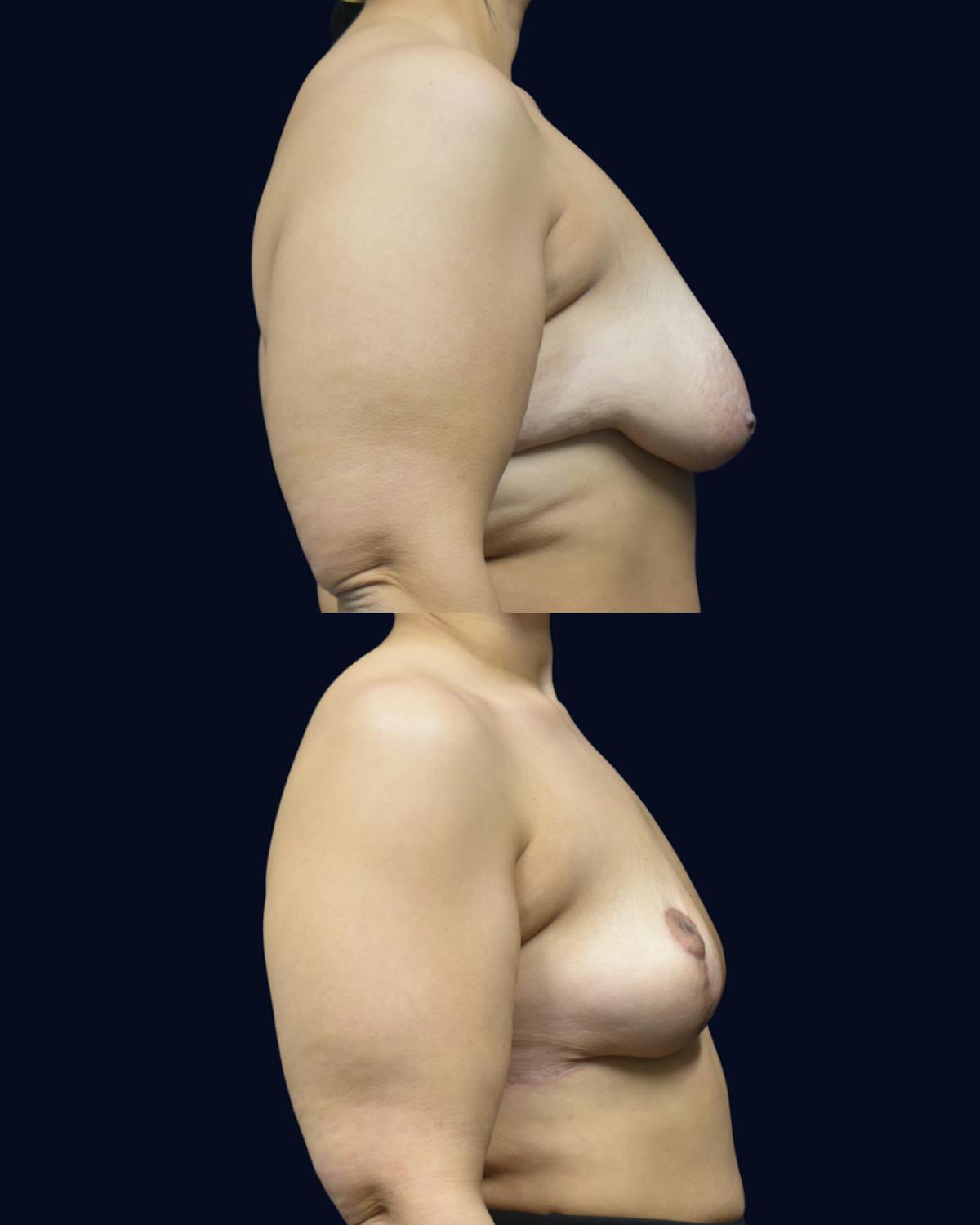 Breast Reduction and Lift Before & After Gallery - Patient 307852 - Image 3