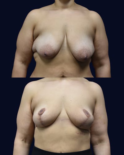 Breast Reduction and Lift Before & After Gallery - Patient 307852 - Image 1