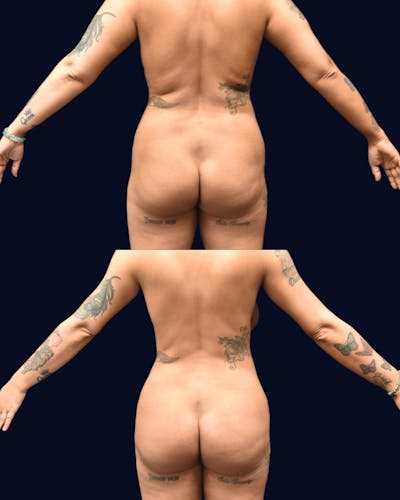 Brazilian Butt Lift Before & After Gallery - Patient 174993 - Image 1