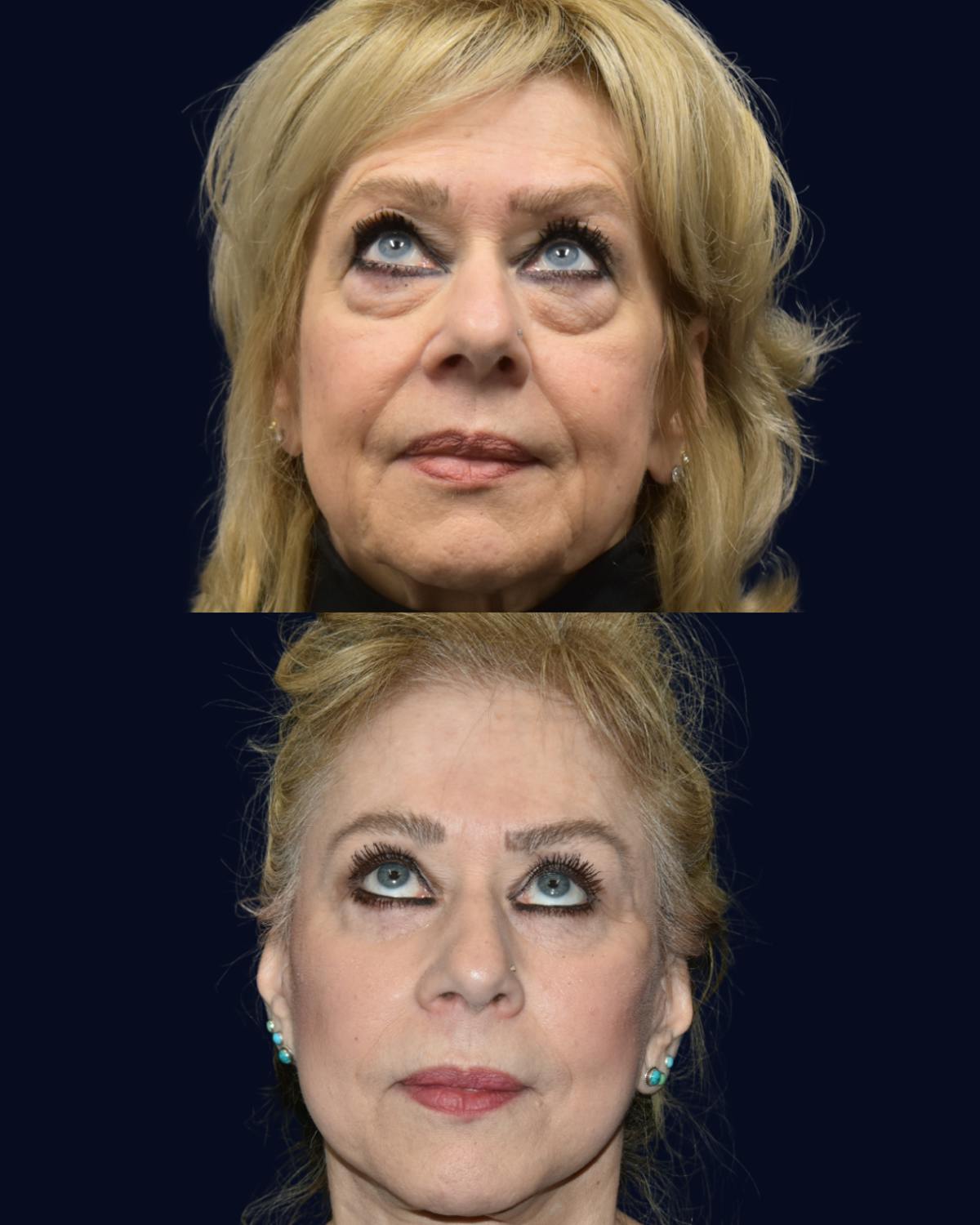 Facelift Before & After Gallery - Patient 335209 - Image 2