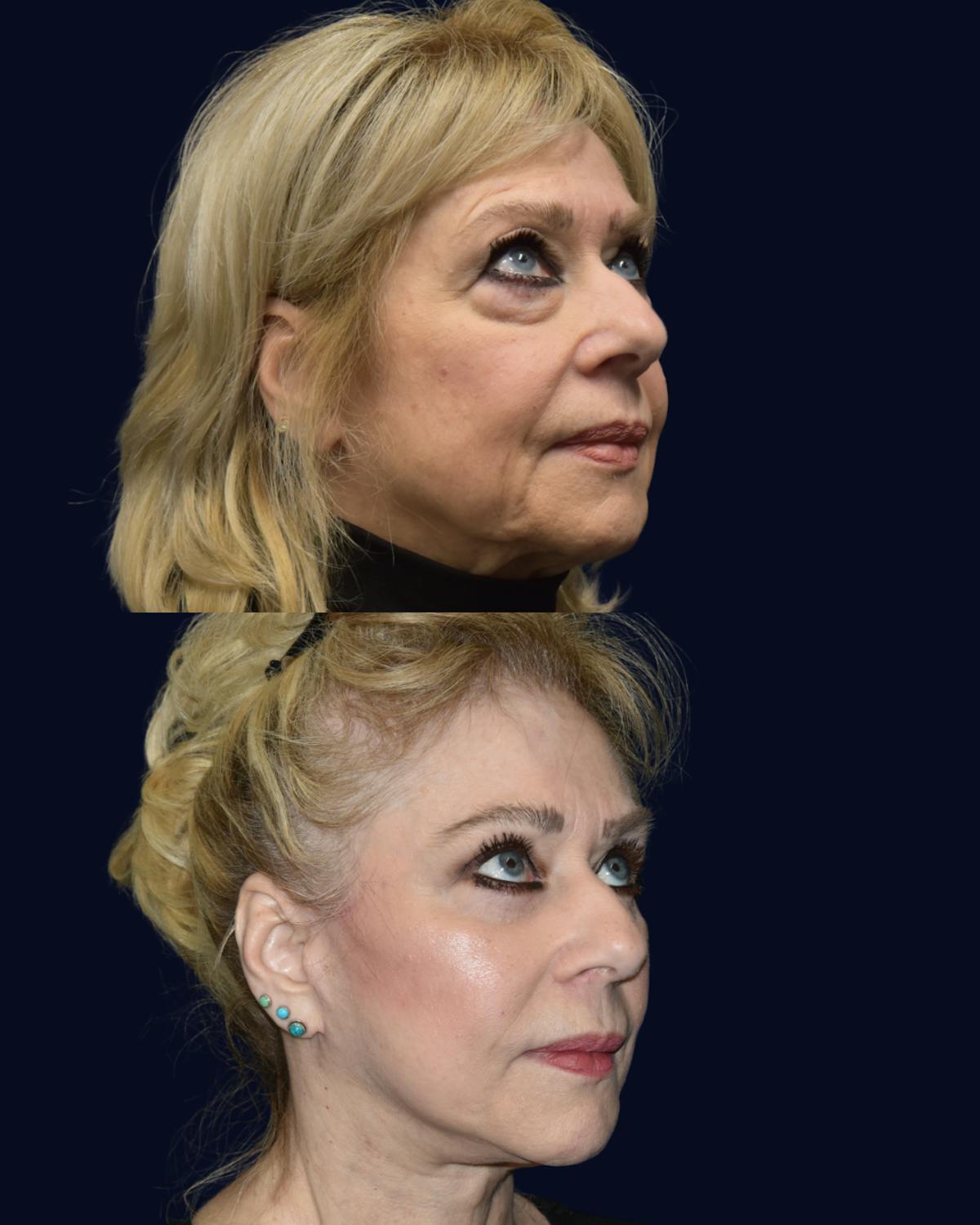 Facelift Before & After Gallery - Patient 335209 - Image 3