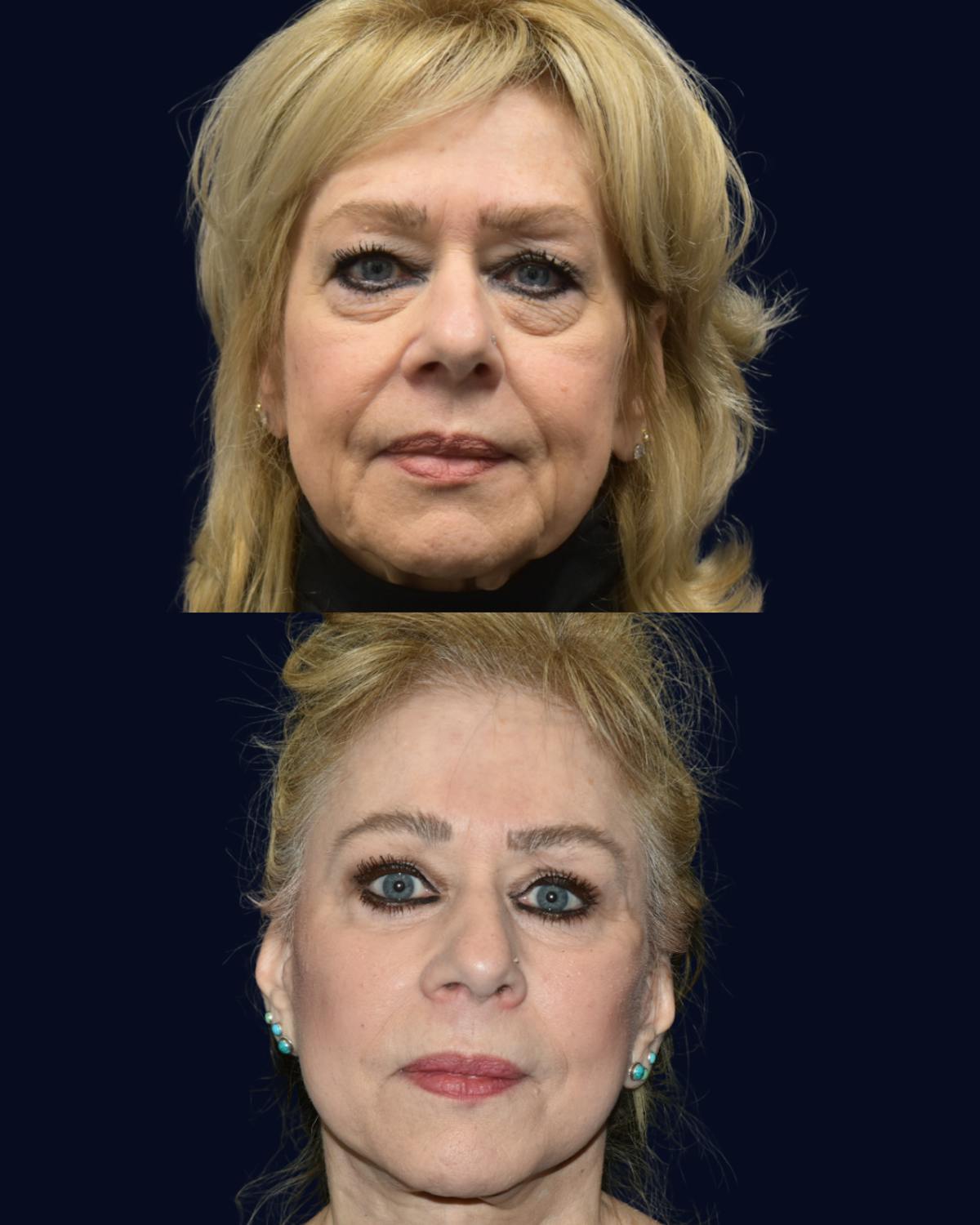 Facelift Before & After Gallery - Patient 335209 - Image 1