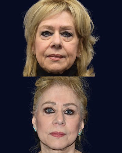 Facelift Before & After Gallery - Patient 335209 - Image 1