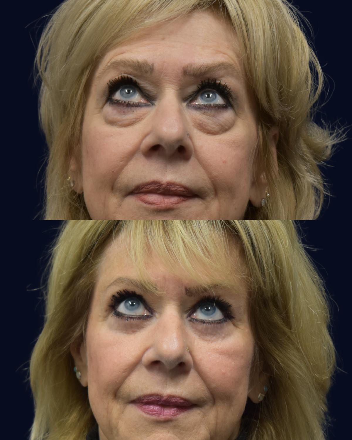 Blepharoplasty (Eyelid Surgery) Before & After Gallery - Patient 162685 - Image 1