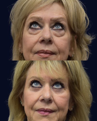 Blepharoplasty (Eyelid Surgery) Before & After Gallery - Patient 162685 - Image 1