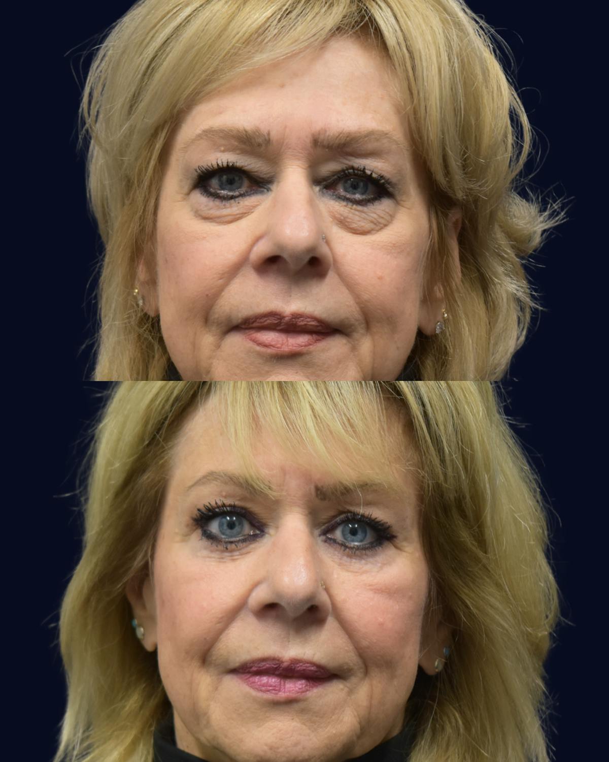 Blepharoplasty (Eyelid Surgery) Before & After Gallery - Patient 162685 - Image 2
