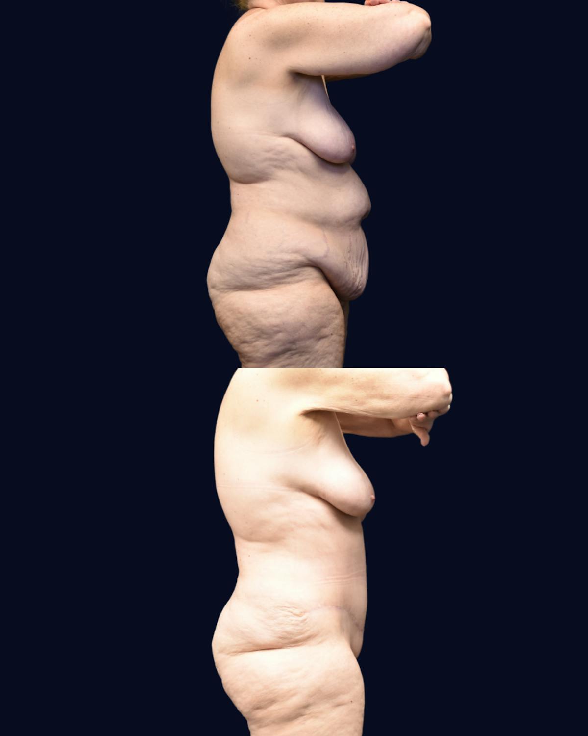 Abdominoplasty (Tummy Tuck) Before & After Gallery - Patient 332537 - Image 2