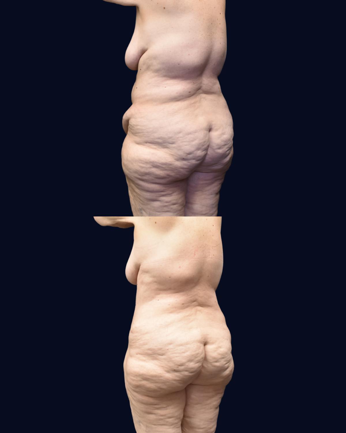 Abdominoplasty (Tummy Tuck) Before & After Gallery - Patient 332537 - Image 3