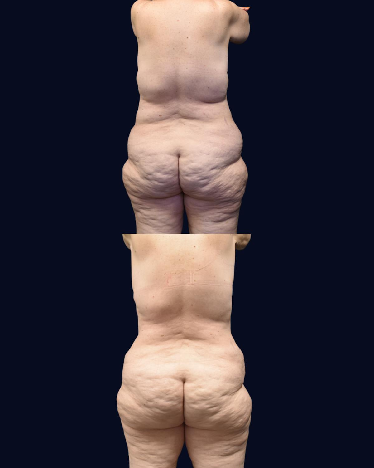 Abdominoplasty (Tummy Tuck) Before & After Gallery - Patient 332537 - Image 4