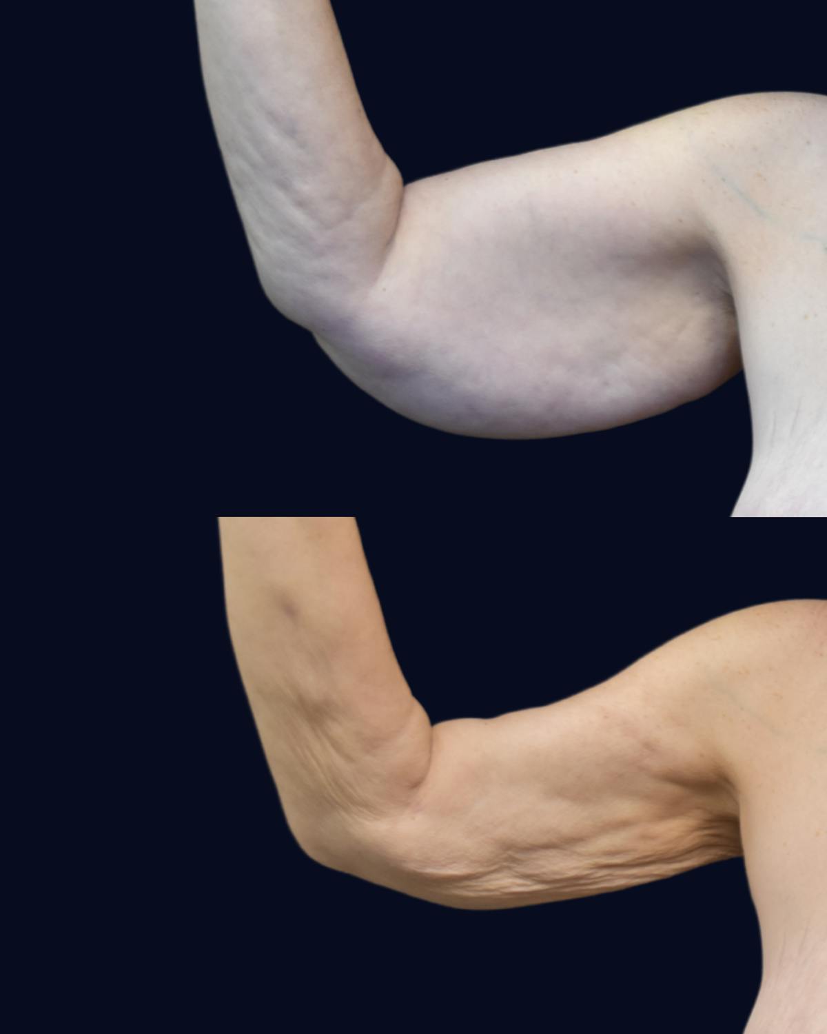 Abdominoplasty (Tummy Tuck) Before & After Gallery - Patient 332537 - Image 6