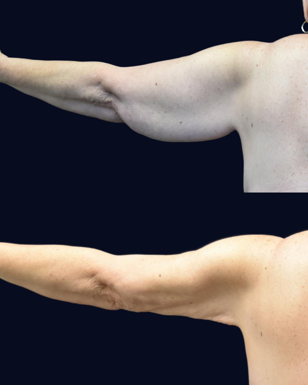 Abdominoplasty (Tummy Tuck) Before & After Gallery - Patient 332537 - Image 5