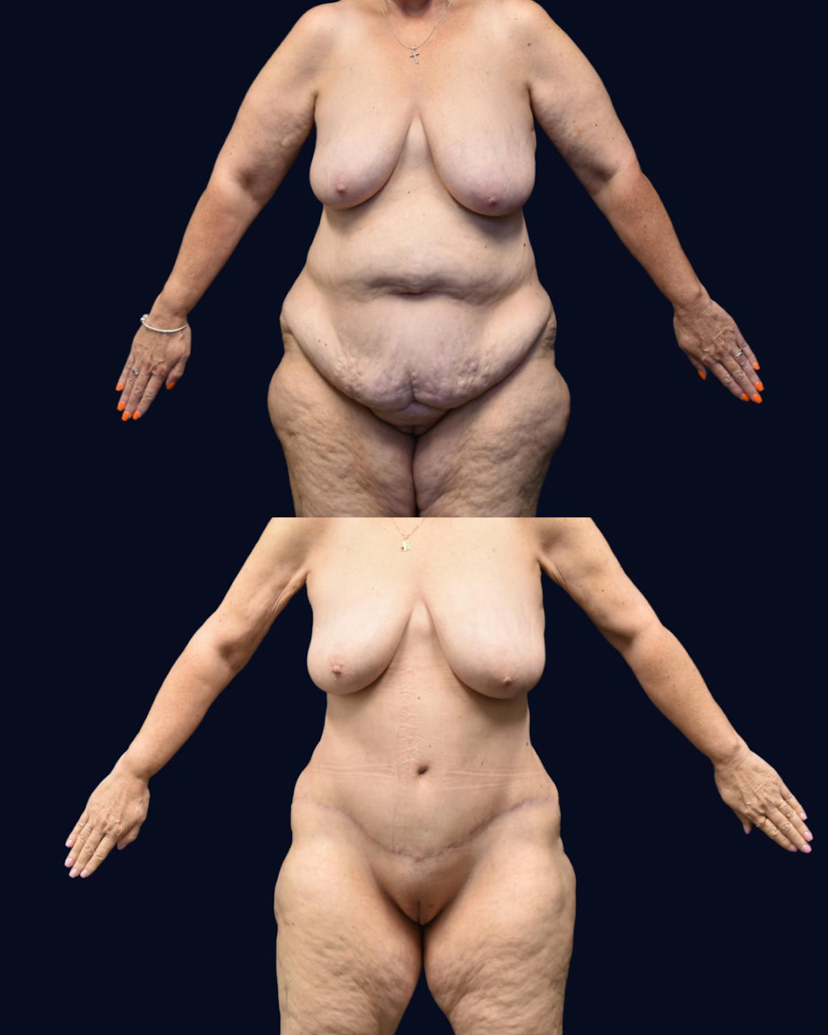 Abdominoplasty (Tummy Tuck) Before & After Gallery - Patient 332537 - Image 1