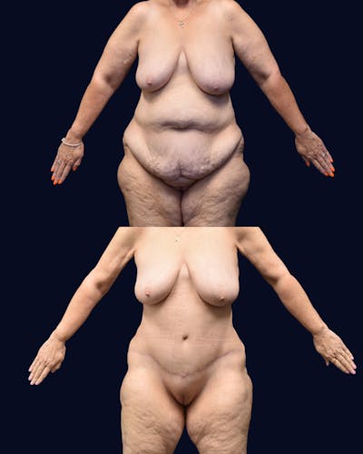 Abdominoplasty (Tummy Tuck) Before & After Gallery - Patient 332537 - Image 1