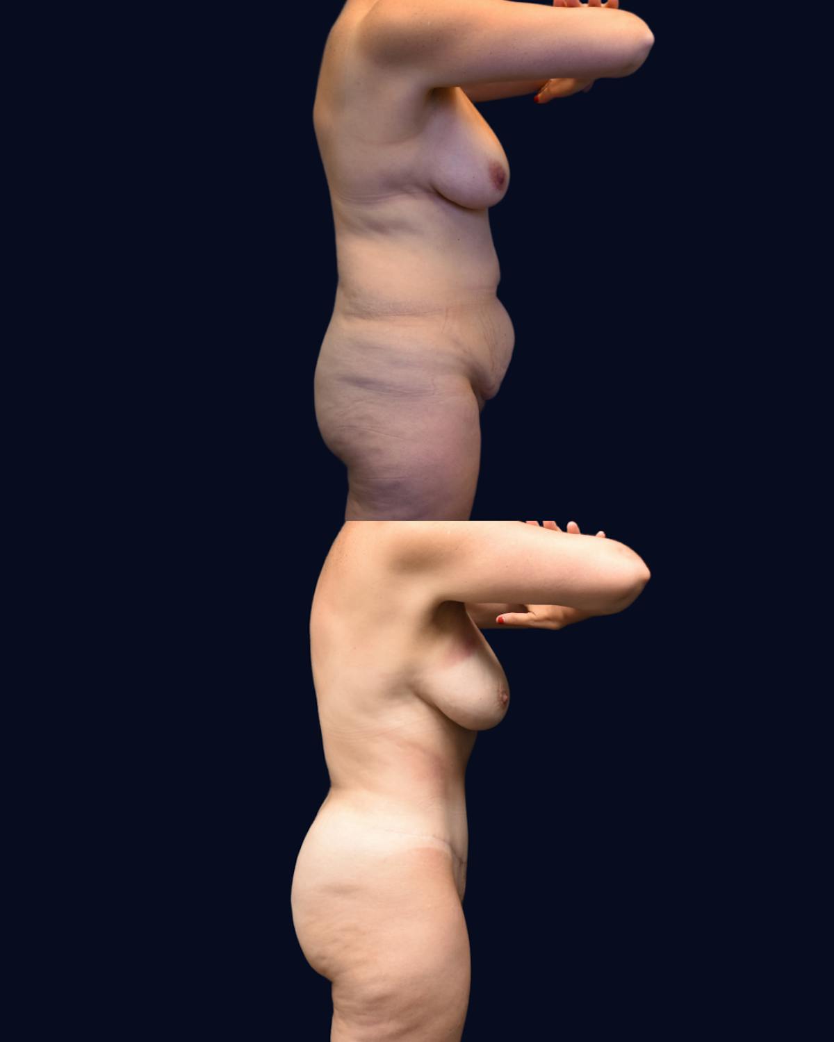 Abdominoplasty (Tummy Tuck) Before & After Gallery - Patient 261067 - Image 3