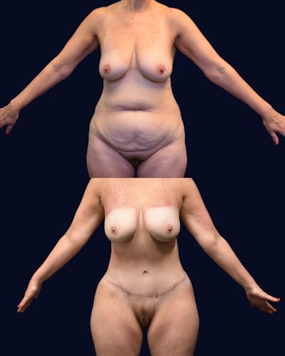 Abdominoplasty (Tummy Tuck) Before & After Gallery - Patient 261067 - Image 1