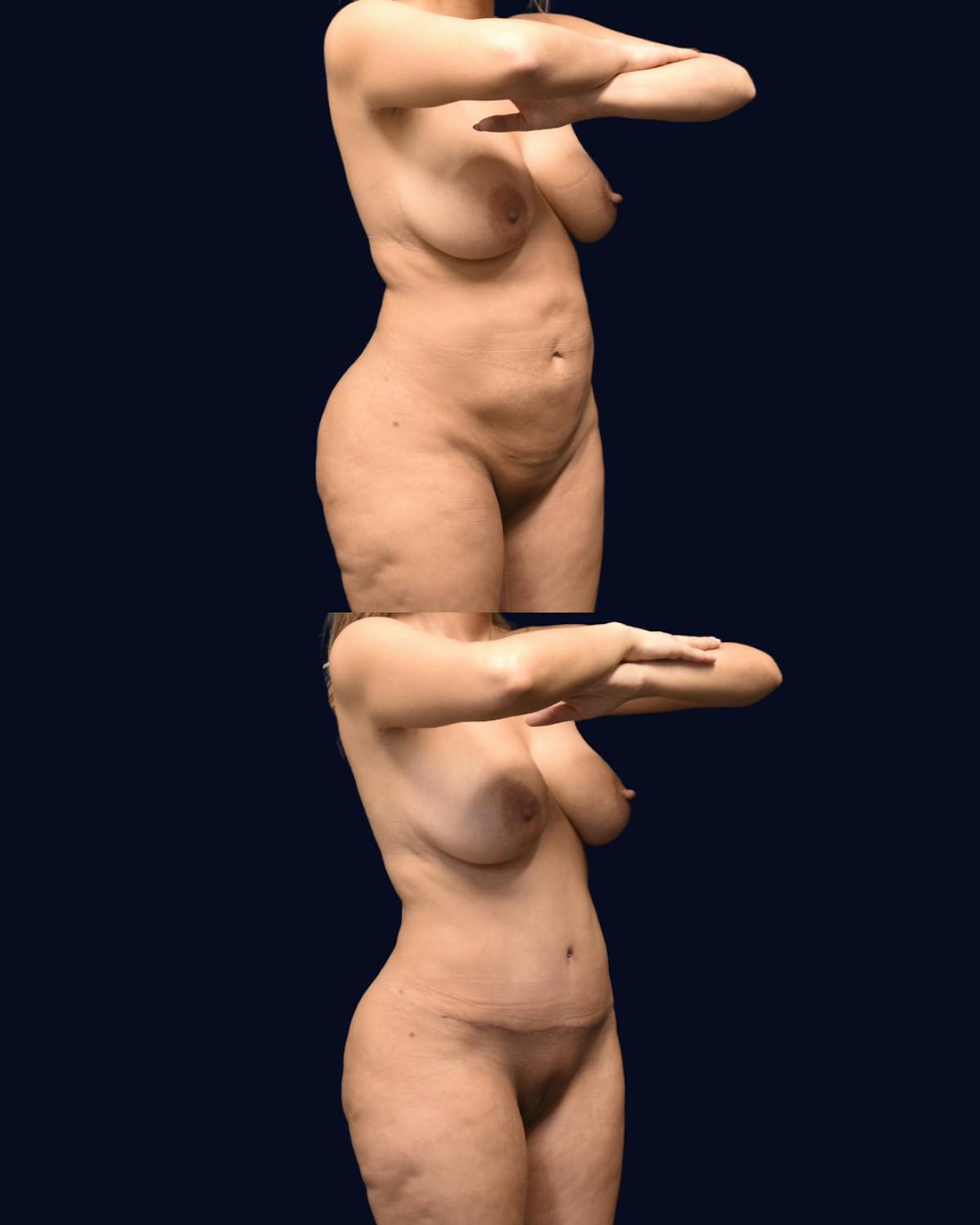 Abdominoplasty (Tummy Tuck) Before & After Gallery - Patient 215963 - Image 3
