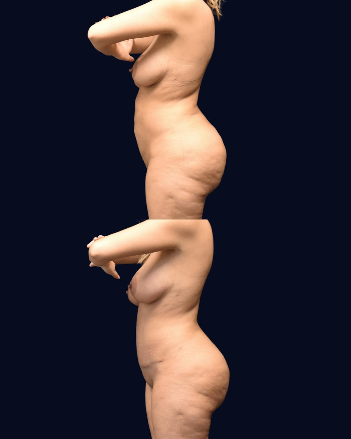 Abdominoplasty (Tummy Tuck) Before & After Gallery - Patient 215963 - Image 4