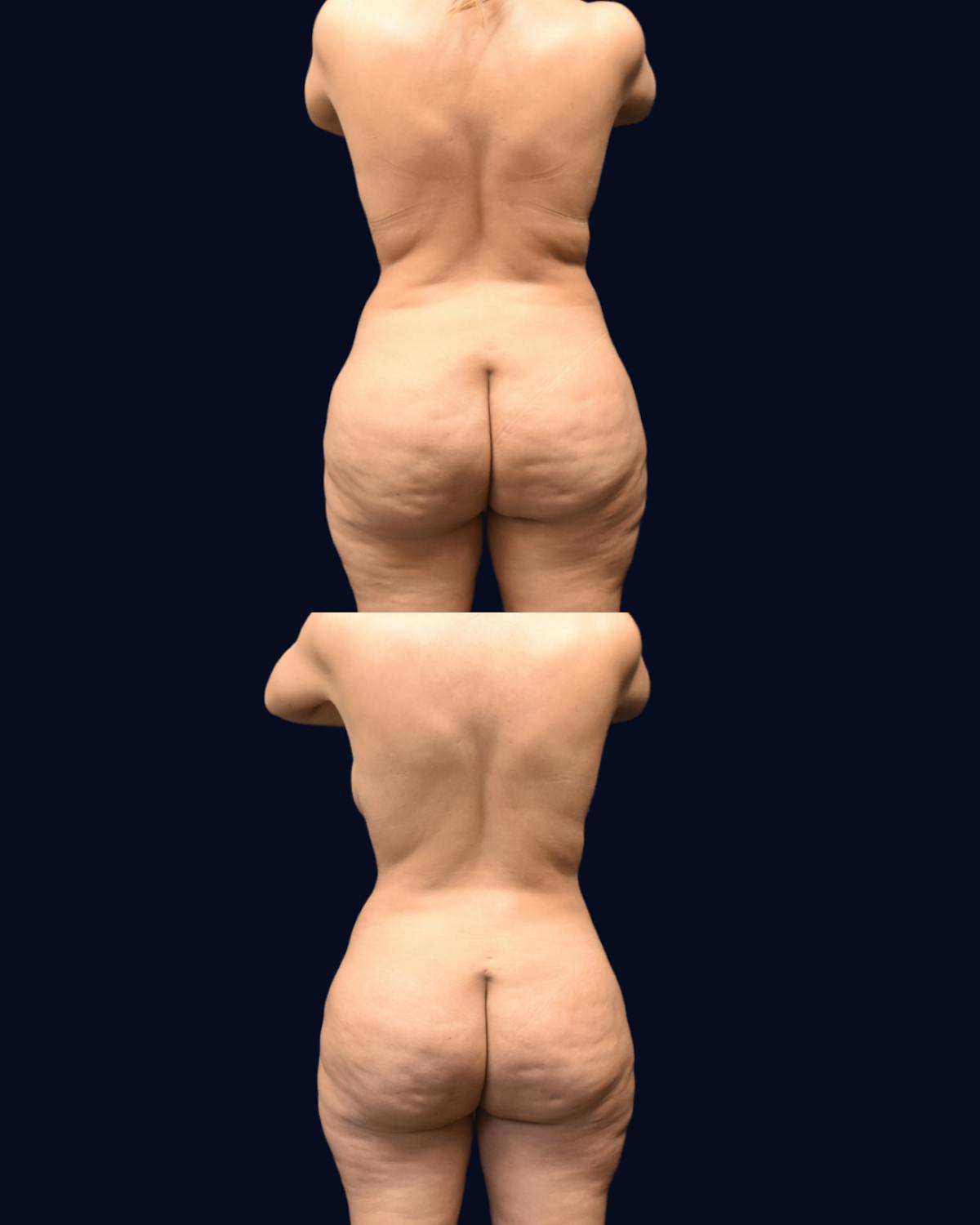 Abdominoplasty (Tummy Tuck) Before & After Gallery - Patient 215963 - Image 5
