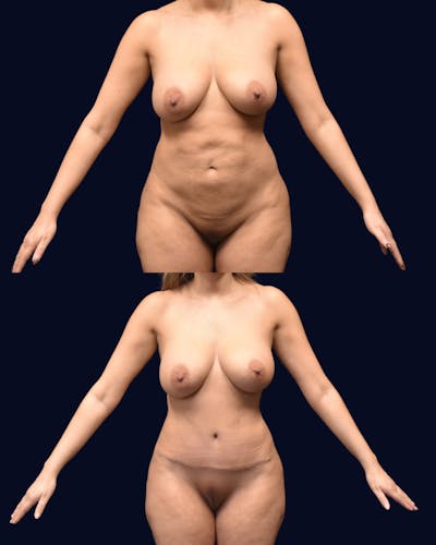 Abdominoplasty (Tummy Tuck) Before & After Gallery - Patient 215963 - Image 1