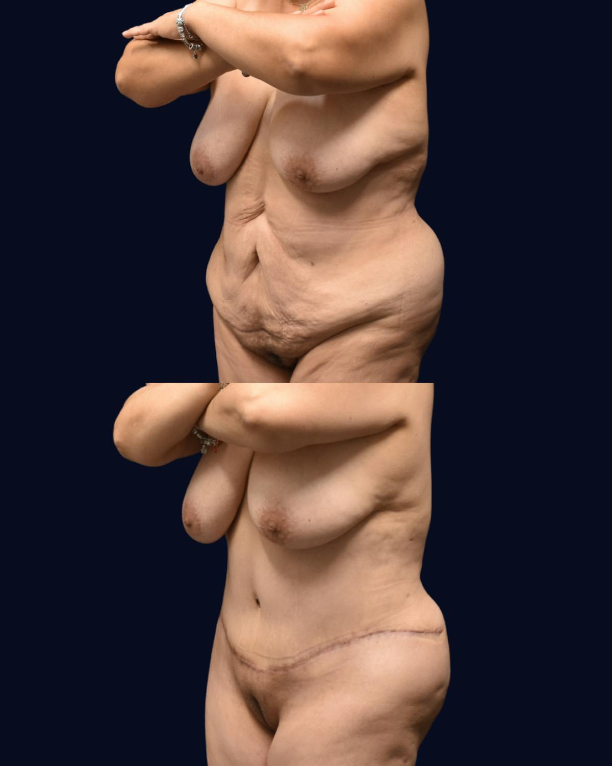 Abdominoplasty (Tummy Tuck) Before & After Gallery - Patient 313070 - Image 2