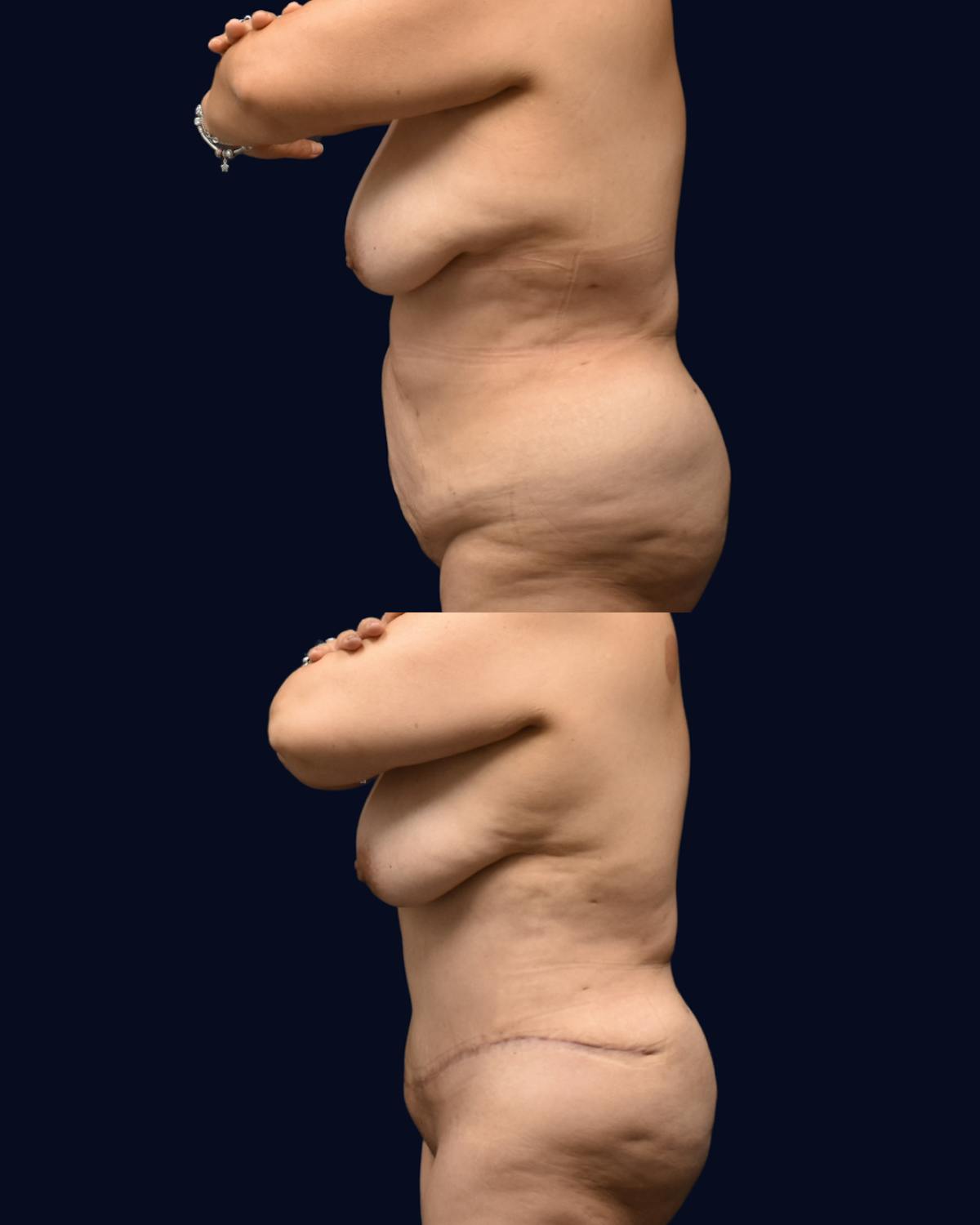 Abdominoplasty (Tummy Tuck) Before & After Gallery - Patient 313070 - Image 3