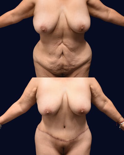 Abdominoplasty (Tummy Tuck) Before & After Gallery - Patient 313070 - Image 1