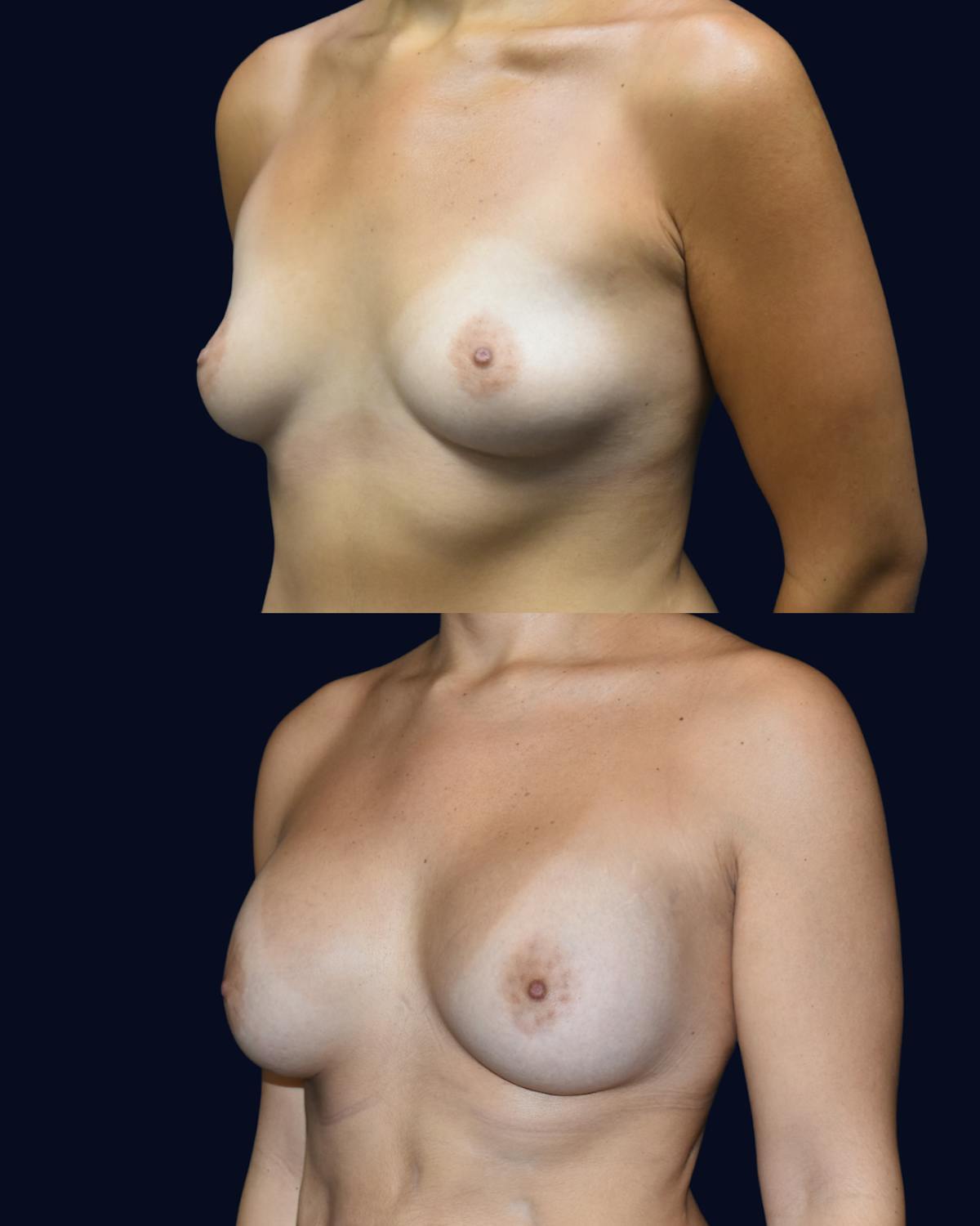 Breast Augmentation Before & After Gallery - Patient 342950 - Image 2