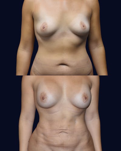 Breast Augmentation Before & After Gallery - Patient 342950 - Image 1