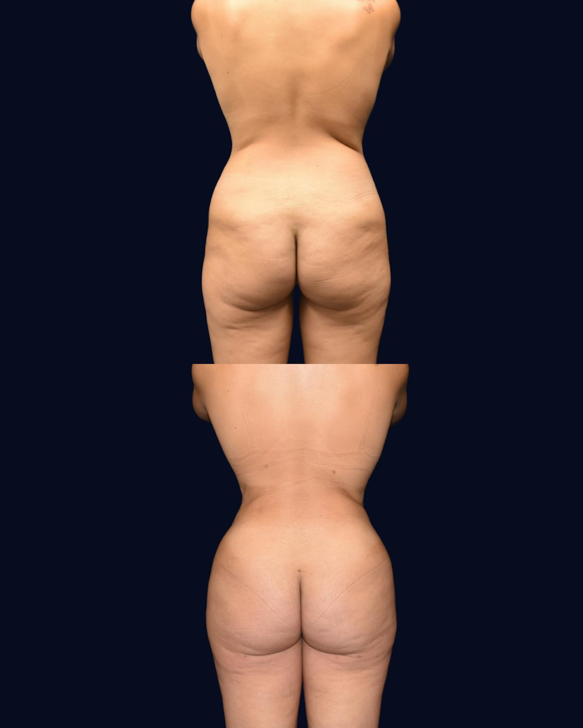 Breast Augmentation Before & After Gallery - Patient 342950 - Image 5