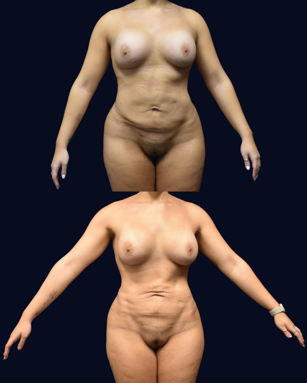 Breast Augmentation Before & After Gallery - Patient 342950 - Image 3