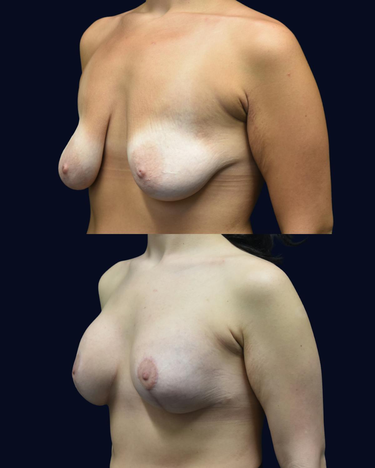 Breast Lift Before & After Gallery - Patient 197240 - Image 2