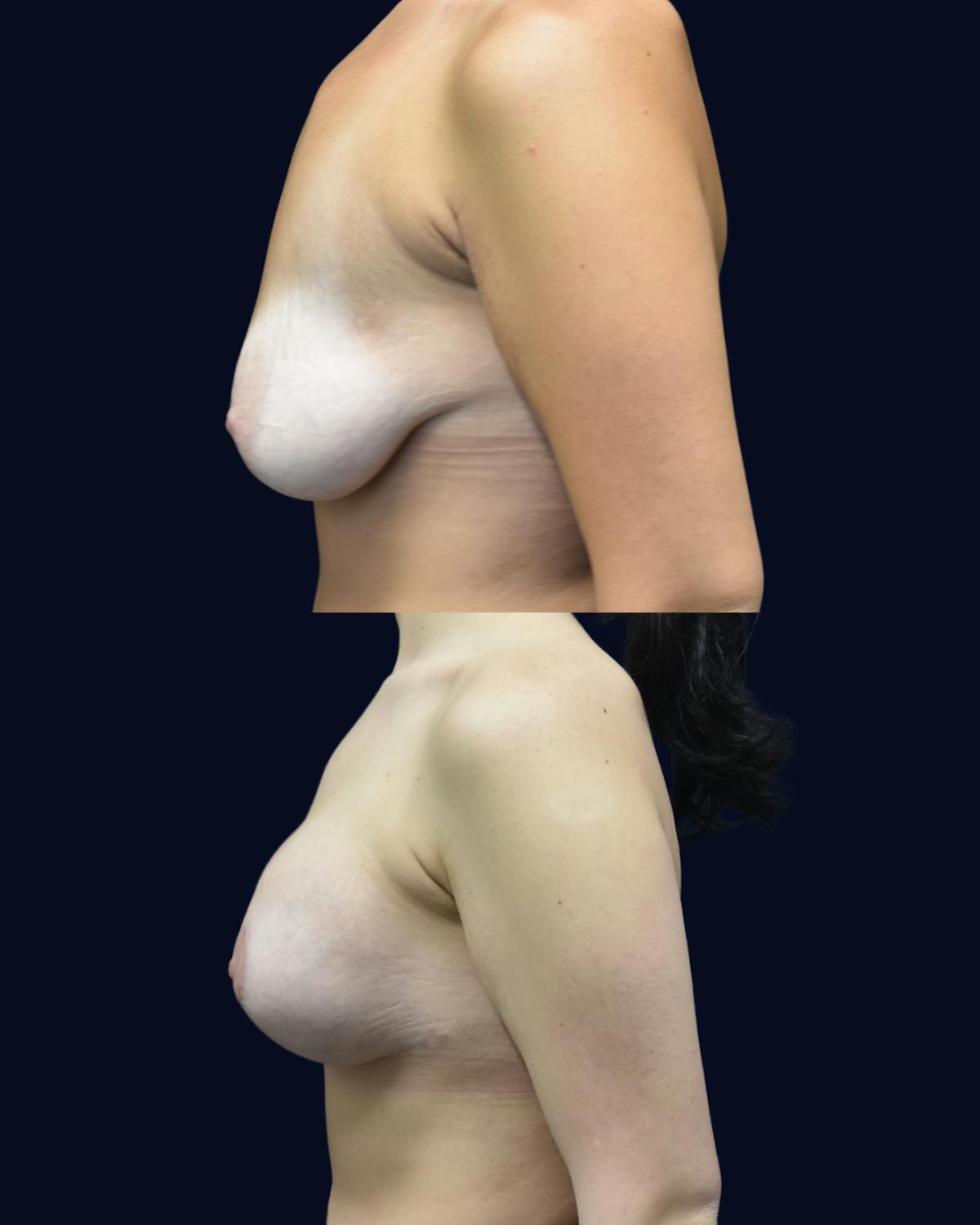 Breast Lift Before & After Gallery - Patient 197240 - Image 3