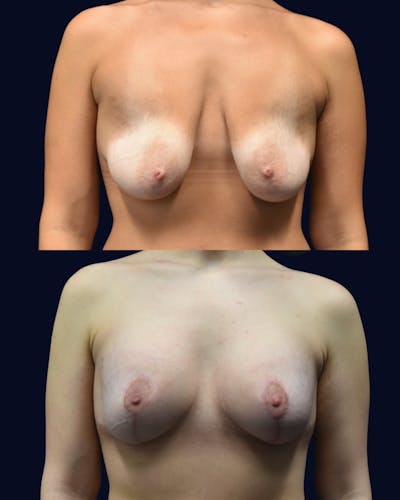 Breast Lift Before & After Gallery - Patient 197240 - Image 1