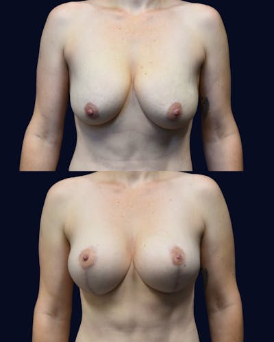 Breast Lift with Implants Before & After Gallery - Patient 255070 - Image 1