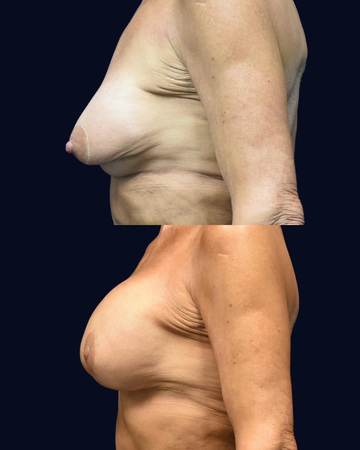 Breast Lift with Implants Before & After Gallery - Patient 256673 - Image 3
