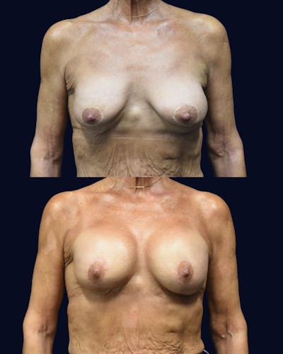 Breast Lift with Implants Before & After Gallery - Patient 256673 - Image 1