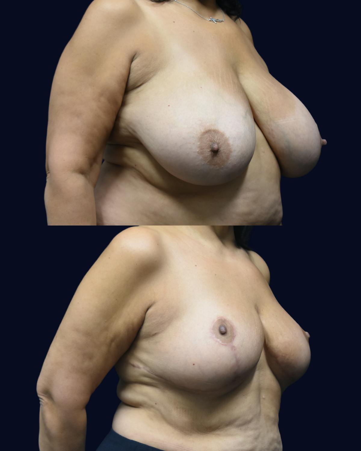 Breast Reduction Before & After Gallery - Patient 934968 - Image 2