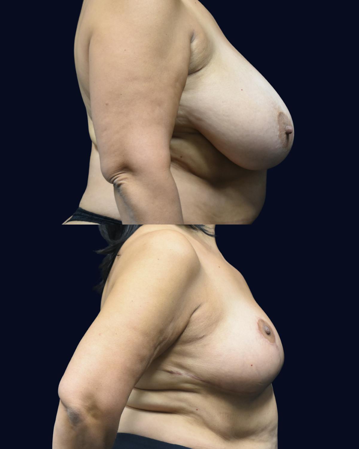 Breast Reduction Before & After Gallery - Patient 934968 - Image 3