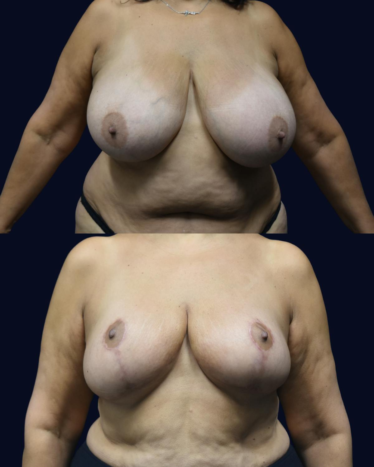 Breast Reduction Before & After Gallery - Patient 934968 - Image 1
