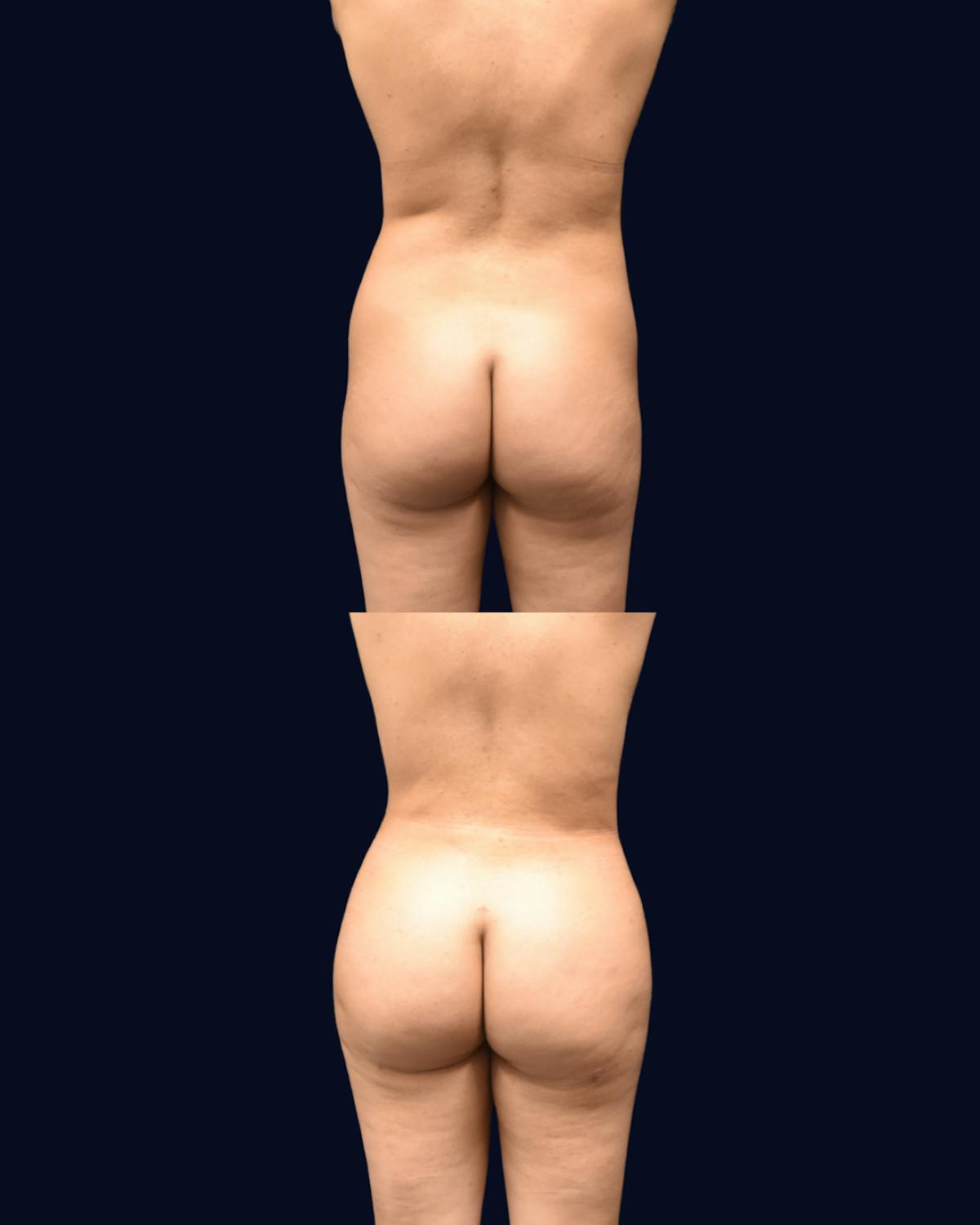Brazilian Butt Lift Before & After Gallery - Patient 601994 - Image 1