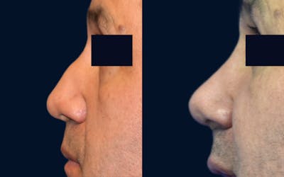 Rhinoplasty Before & After Gallery - Patient 104507 - Image 1