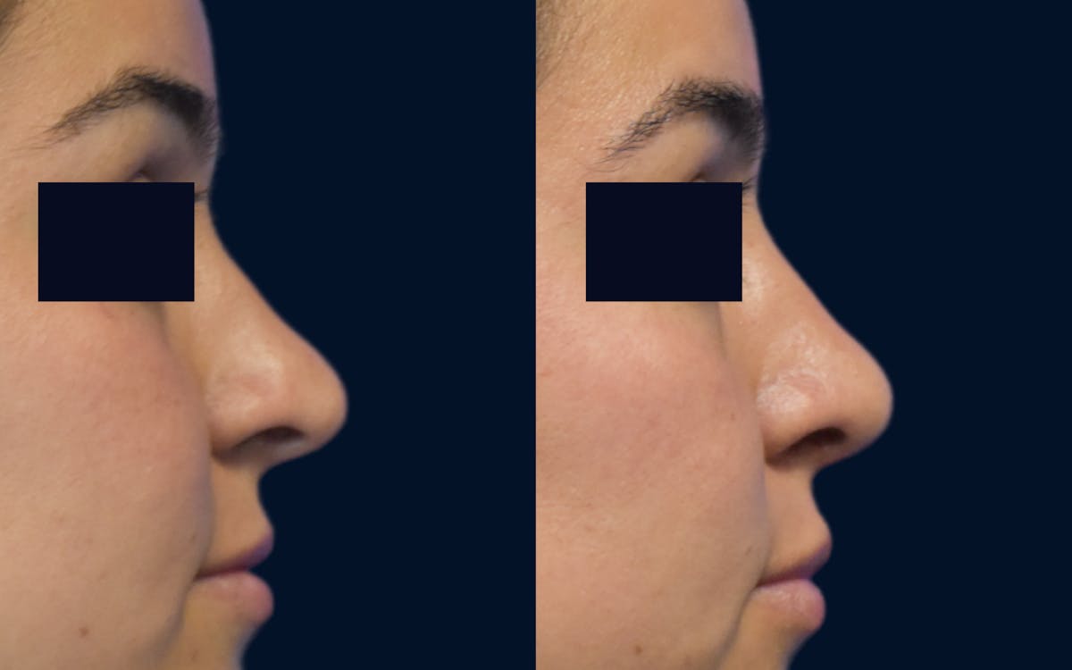 Rhinoplasty Before & After Gallery - Patient 231462 - Image 1