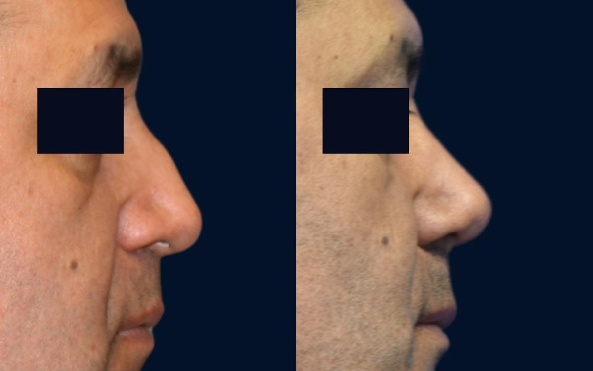 Rhinoplasty Before & After Gallery - Patient 104507 - Image 2
