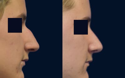 Rhinoplasty Before & After Gallery - Patient 356993 - Image 1