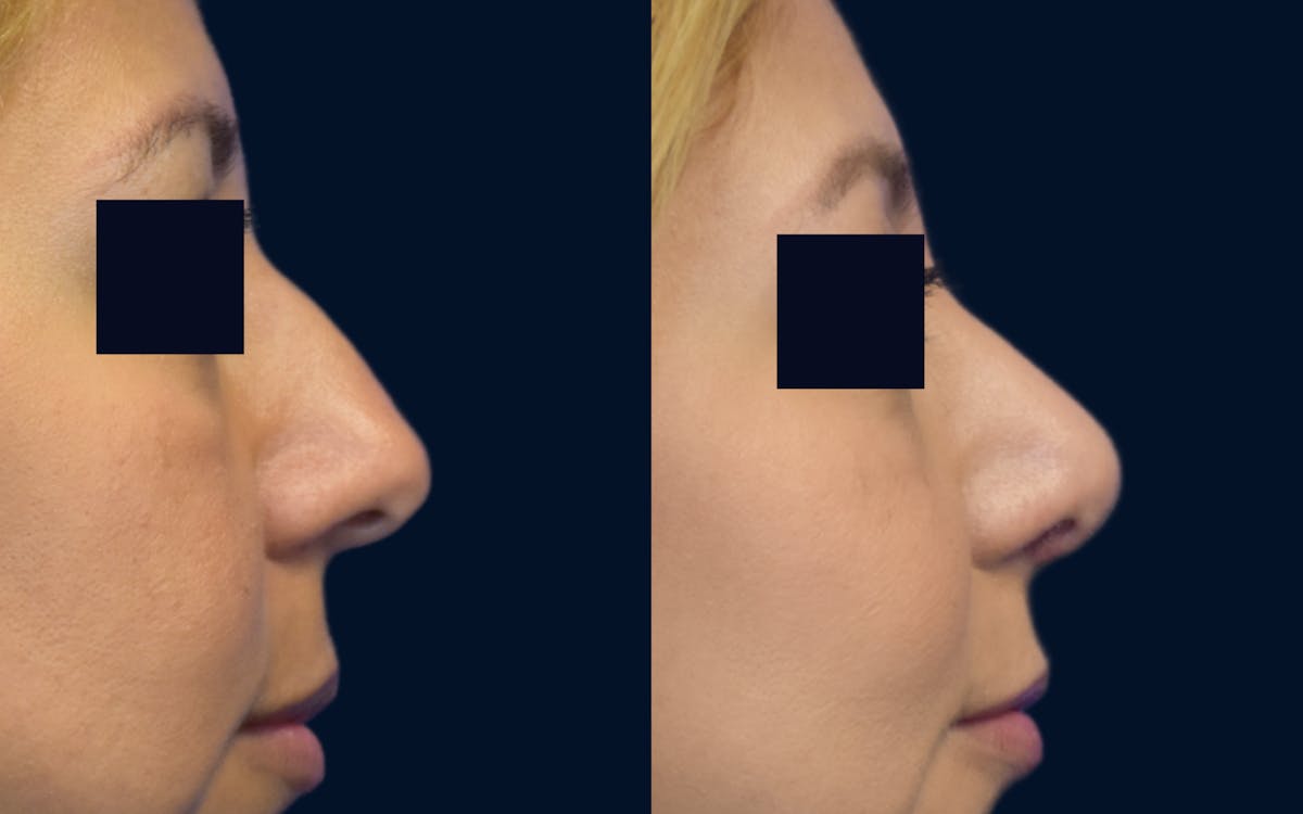 Rhinoplasty Before & After Gallery - Patient 395029 - Image 2