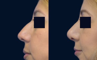 Rhinoplasty Before & After Gallery - Patient 395029 - Image 1